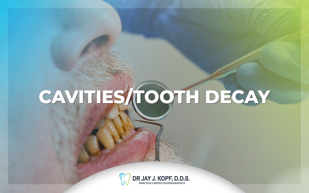 Cavities/tooth decay