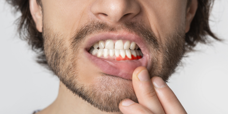 How gum disease evolve?